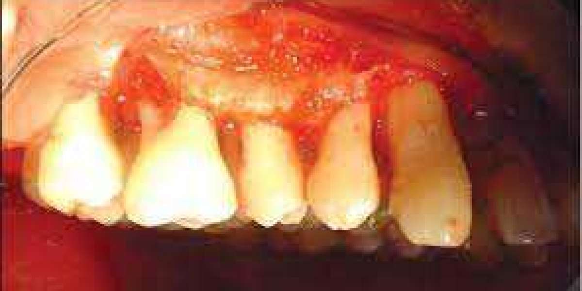 Everything You Need to Know About Tooth Root Amputation