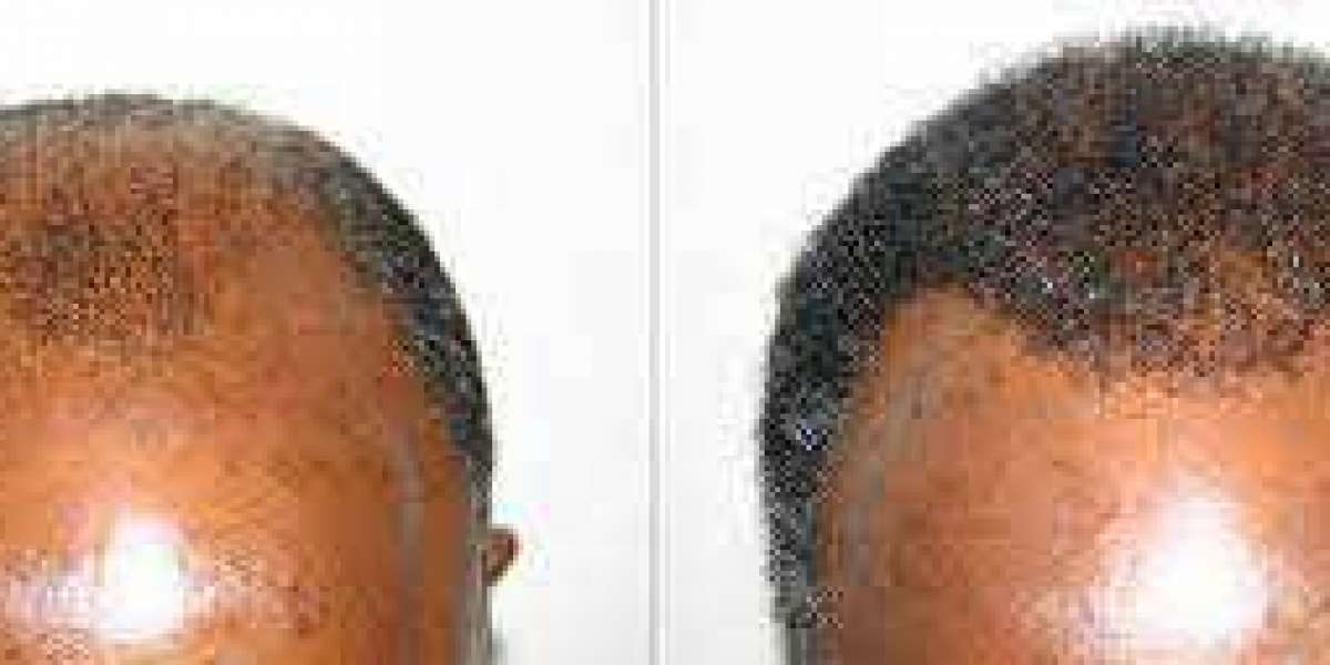 Scalp Micropigmentation Hair Restoration