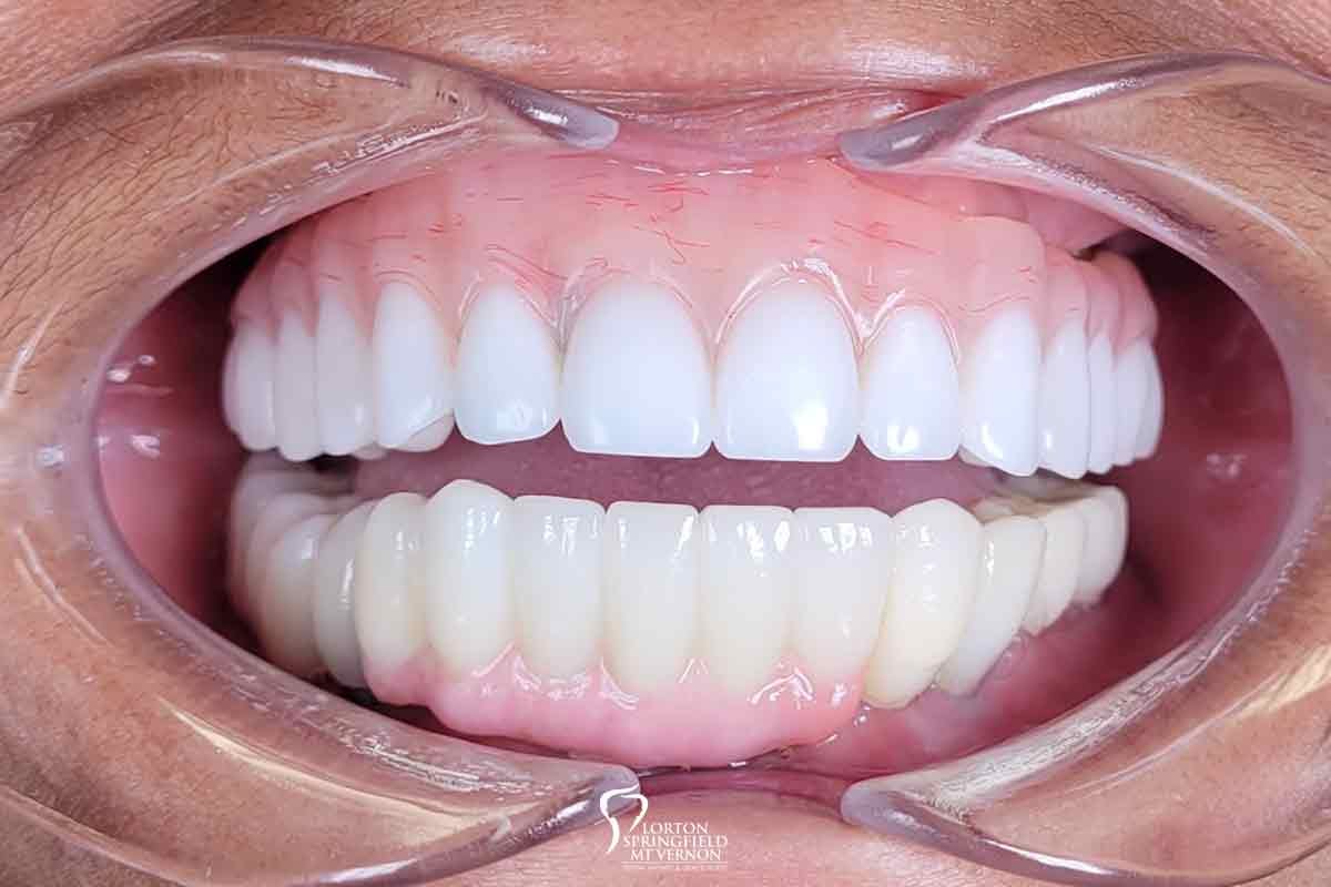 Dental Implants: More Stable & Natural Smile | by Merrifield Smiles | Sep, 2023 | Medium