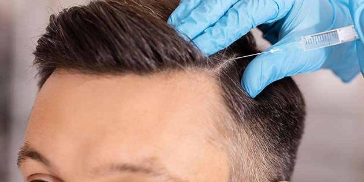 How Hair Transplants Can Improve Self-Esteem