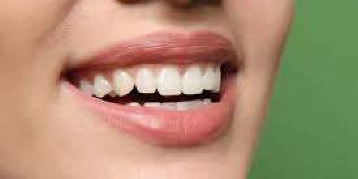 Transform Your Smile with Porcelain Veneers in Fort Lauderdale
