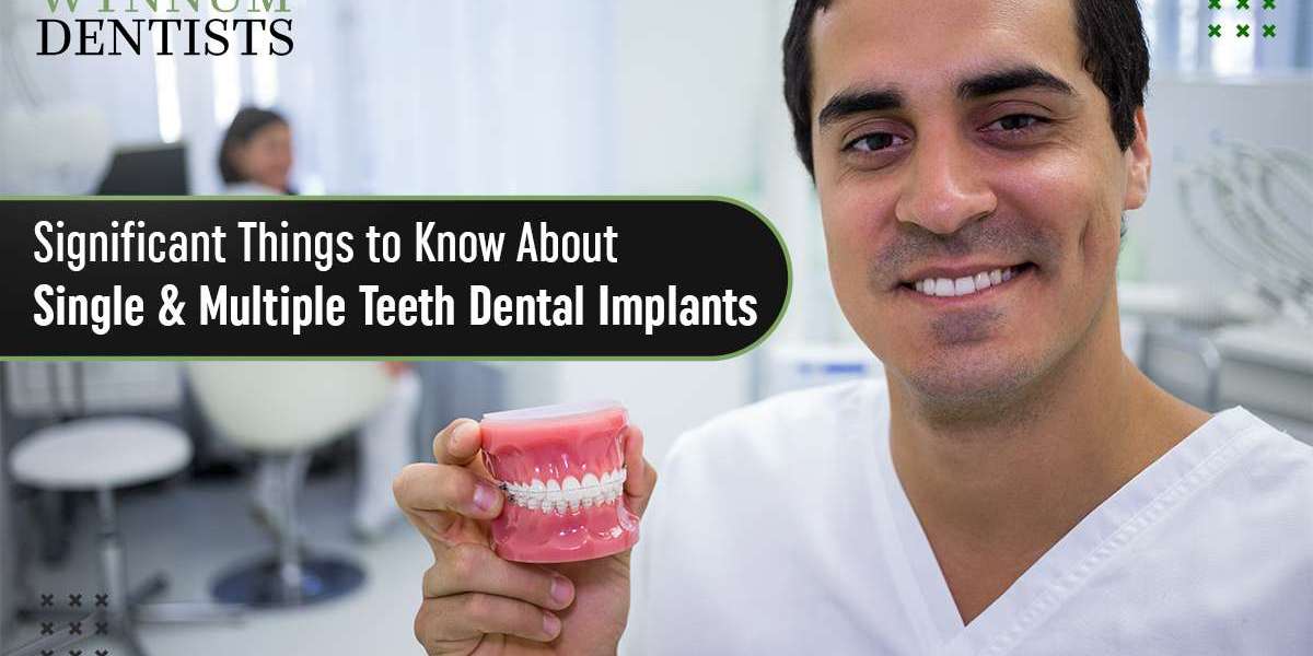 Significant Things to Know About Single and Multiple Teeth Dental Implan