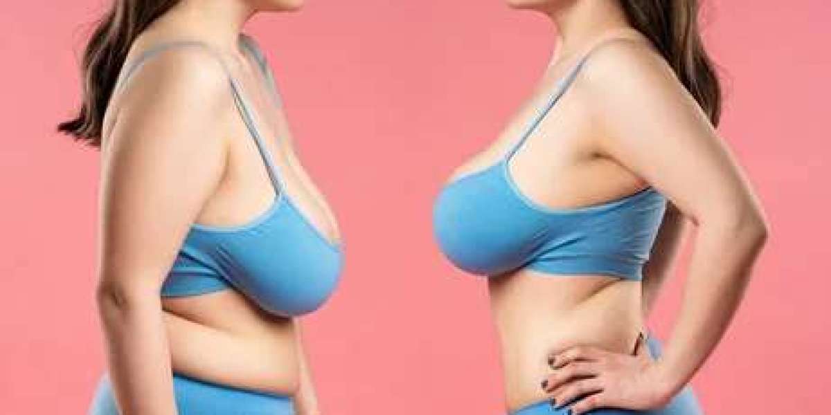 Achieve Your Dream Body with Dr. Todd: Expert Tummy Tuck and Breast Augmentation in Buffalo, NY