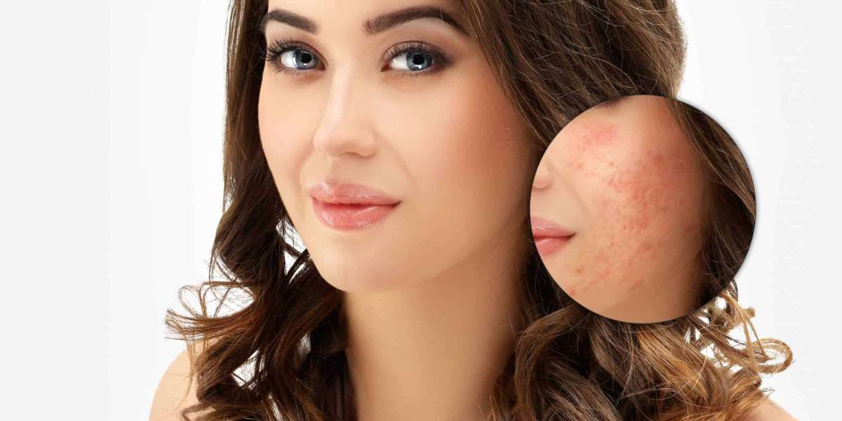 Transform Your Skin's Texture: Acne Scar Removal in Kolkata