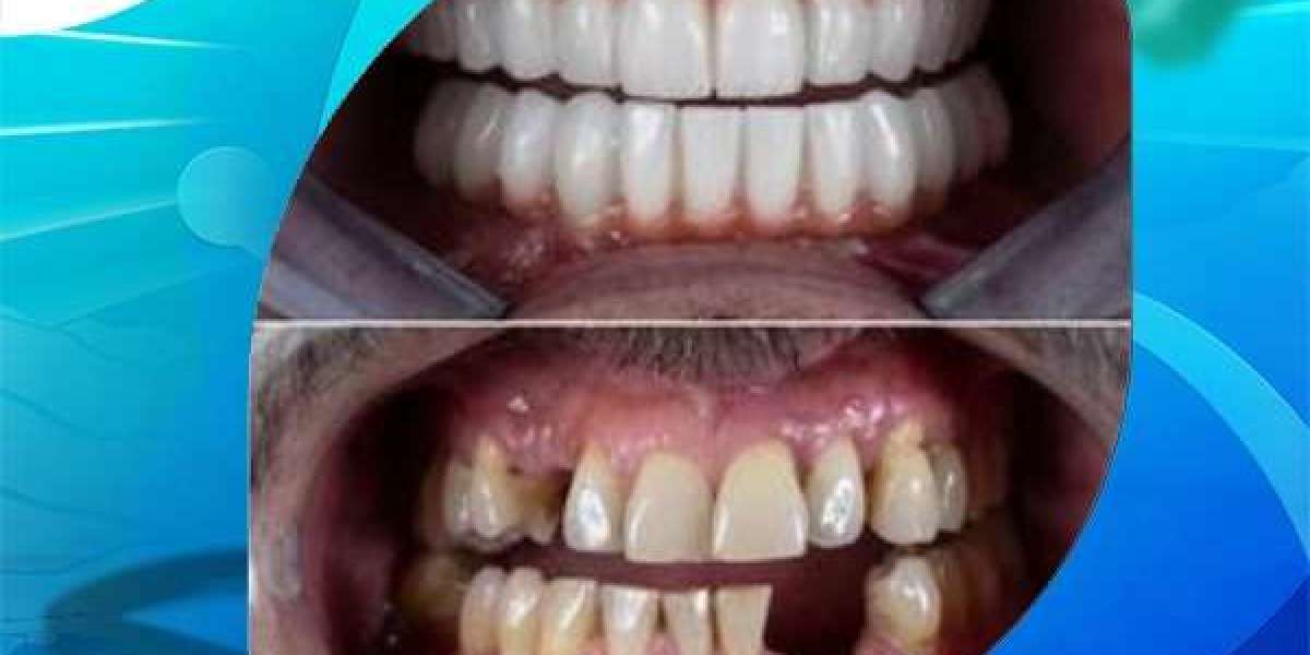 ما هي تركيب اسنان3D  وما اسباب فشلها