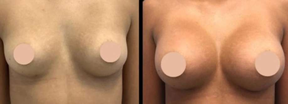 Breast Augmentation Cover Image