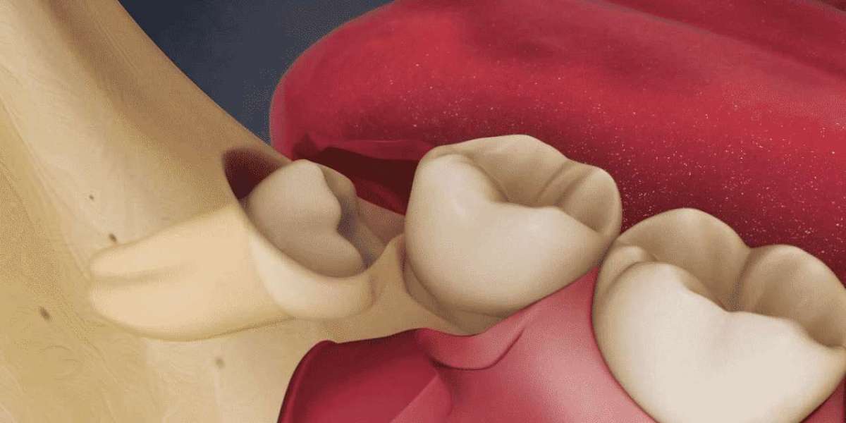 Wisdom Teeth Removal in Nottingham: Safe, Simple & Stress-Free