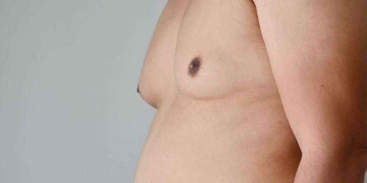 Personalizing Care: Tailored Approaches in Gynaecomastia Treatment